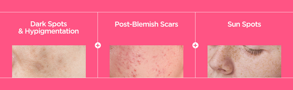 anua dark spot serum